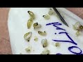 big cystic acne blackheads extraction blackheads u0026 milia whiteheads removal pimple popping 3798