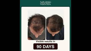Best Hair Loss Treatment. No Pain, Cost-effective and better than laser hair treatments!