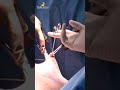 gynecomastia surgery at tamiralife man boobs gynecomastia before and after