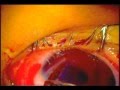 عملية جرح قرنية - الدكتور عادل الكرعاوي - Corneal Wound - Dr. Adil Algarawi