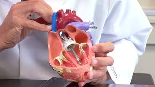 IMPELLA 5.5: WORLD’S SMALLEST HEART PUMP GETS EVEN BETTER!