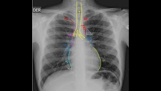 Radiografía de Tórax, Anatomía y la importancia del análisis sistemático