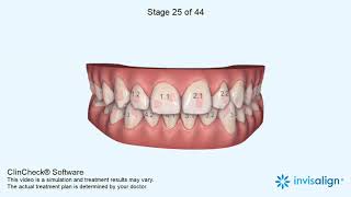 Invisalign Clincheck