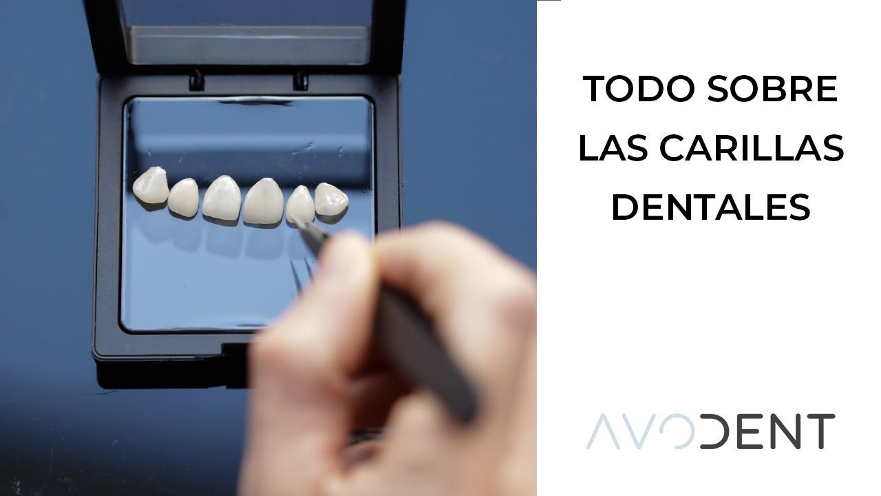 Carillas Dentales: ¿qué Son, Qué Tipos Hay Y Cuándo Duran? | Clínica ...