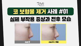 코 보형물 제거로 걱정 중이라면❓ 사례를 확인해 보세요 #01