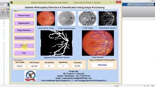Diabetic Retinopathy Detection and Classification Using Image Processing full Matlab Project Code