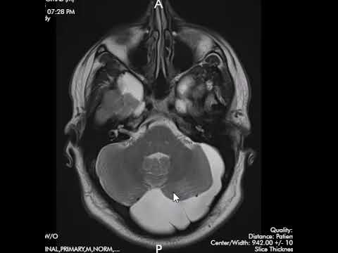 How can you tell the difference between arachnoid cyst and mega cisterna magna?