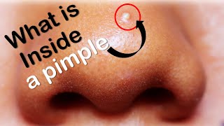 What is Inside A Pimple?