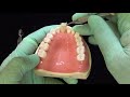 direct composite veneers using the bioclear uveneer process