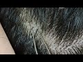 Relaxing dandruff removal | visual ASMR to relax your mind (w/ background music #relaxing