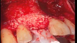 RETAINED INCISOR AND RECONSTRUCTION WITH A BOX-TECHNIQUE™.mov