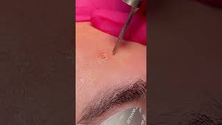 Laser Mole Removal #shorts #shortvideo