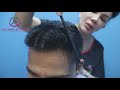 TESTIMONIAL AFTER FUE | Iplus Hair Regrowth Expert