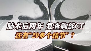 肺结节术后两年，复查扫出20多个结节，不知所措！这可咋办？