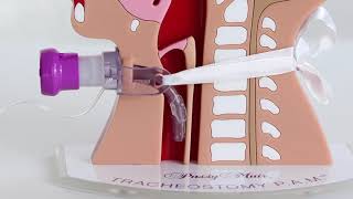 Tracheostomy PAM: Valve Placement and Removal