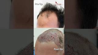 Same Day Result of Hair Transplant | Hair Transplant Before and After #shortsfeed #shorts
