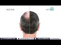 क्या हेयर ट्रांसप्लांट के बाद दवा लेना जरूरी है hair transplant surgery in delhi dr. pk talwar