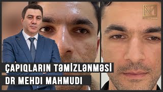 Çapıqların təmizlənməsi / Subcision + punch elevation in acne scars treatment / Dermatolog Dr Mehdi