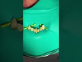 Isolating teeth for root canals with rubber dam #rootcanal #dentist #rubberdam #rootcanaltreatment