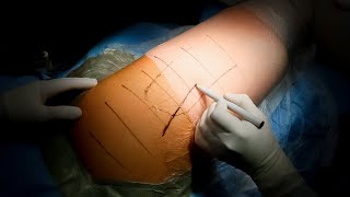 Open Surgical Decompression for Piriformis Syndrome