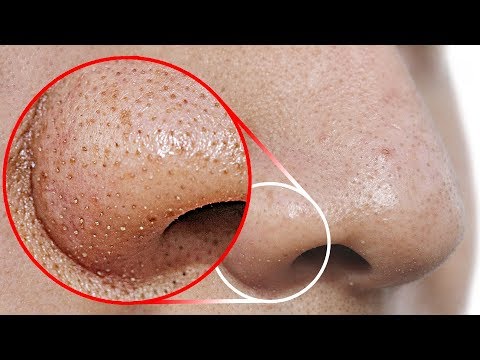 Do THIS to Remove Blackheads From Your Nose Do THIS to Remove Blackheads From Your Nose