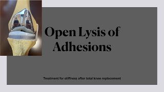 Open Lysis of Adhesions. Surgical treatment for severe stiffness after total knee replacement