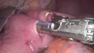 Laparoscopic Gastrojejunostomy