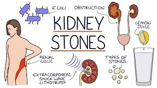 Understanding Kidney Stones