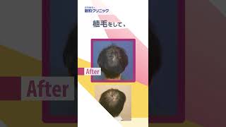 【植毛1年後】前頭・頭頂部に2000株移植された体験者様へお話を伺いました。親和クリニック【 新宿・名古屋・大阪・福岡 】#shorts