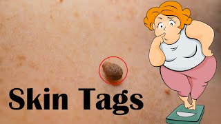 Skin Tags (Acrochordon) - Causes, Signs \u0026 Symptoms, And Treatment