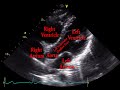 Echocardiogram Apical Five Chamber View - Loop