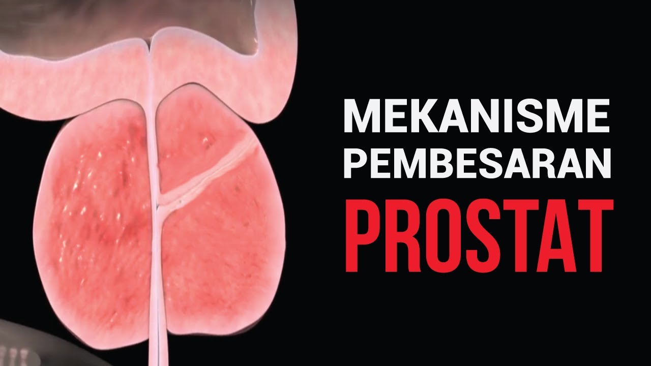 Mekanisme Prostat Membesar Dan Program Save Prostat Al Kindi - YouTube