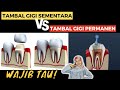 PERBEDAAN TAMBAL GIGI SEMENTARA DAN TAMBAL GIGI PERMANEN. TAHAN BERAPA LAMA?