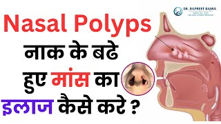 Nasal Polyps - नाक के बढे हुए मांस का इलाज कैसे करे || Nasal Polyps Symptoms, Causes, Treatment