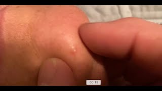 PIMPLE POP ON CHIN - LOUD EXPLOSION, #pimplepoppers