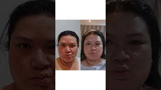 ตัวอย่างเคสคนไข้ที่มาฝังเข็มรักษาอาการ Bell's Palsy  #บ้านหมอเหมียวคลินิกการแพทย์แผนจีน