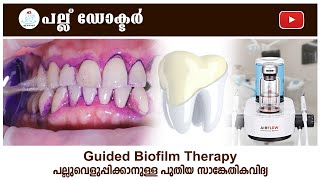 Guided Biofilm Therapy - പല്ലുവെളുപ്പിക്കാനുള്ള പുതിയ സാങ്കേതികവിദ്യ