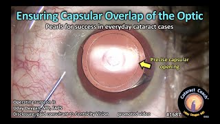 CataractCoach™ 1687: ensuring capsular overlap of the optic