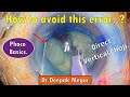 Phaco Basics. Direct Vertical Chop..How to avoid this error..? - Dr Deepak Megur