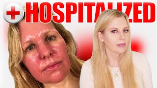 Skin Cancer Treatment Levulan Blue Light / Photodynamic Therapy | My Full Experience
