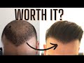 Is Getting A Hair Transplant Worth It?