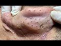 Big Cystic Acne Blackheads Extraction Blackheads & Milia, Whiteheads Removal Pimple Popping # 397