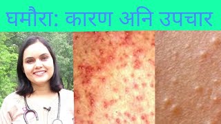 Heat rash in Nepali|Dr Suchana Marahatta|doctor sathi