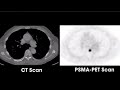 What is PSMA-PET Scan Radioactive Imaging?