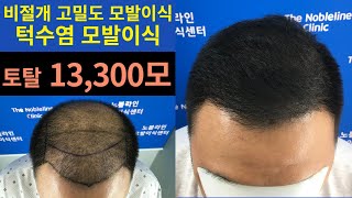 턱수염으로 모발이식 5500모낭, 13300모 M자+정수리 대량모발이식