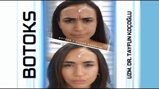 Botoks Öncesi Sonrası | Botox Before After