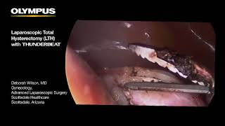 Total Laparoscopic Hysterectomy with THUNDERBEAT