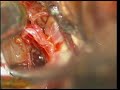 brain aneurysm acom a opening of lamina terminalis dr suresh dugani hubli india