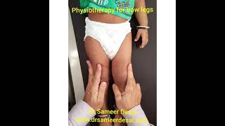 physiotherapy for bow legs in children