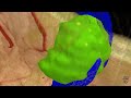 mayo clinic minute treatment and research of glioblastoma